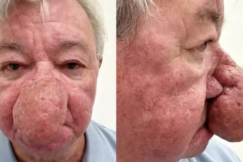 Homem com nariz gigante se submete a cirurgia para reparar condição rara: ‘Difícil beijar minha esposa’