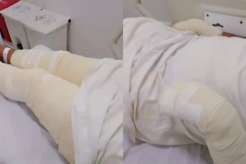 Homem é suspeito de tentar matar irmão queimado enquanto ele dormia no Ceará