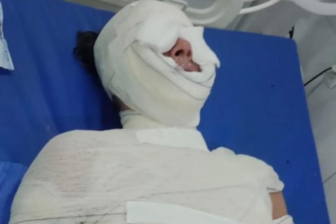 Dona de casa sofre graves queimaduras após explosão de panela na zona rural de Aurora no Ceará